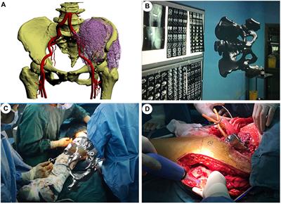 Applications of Mixed Reality Technology in Orthopedics Surgery: A Pilot Study